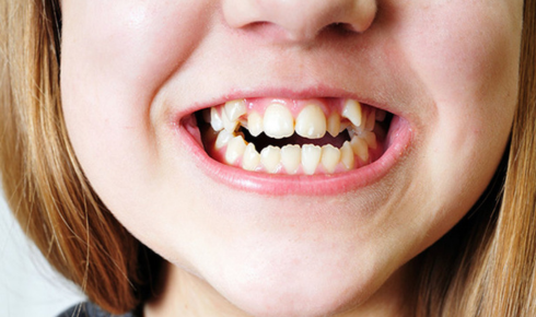 How Mouth Breathing Affects Teeth, Gums and Jaw Development Over Time